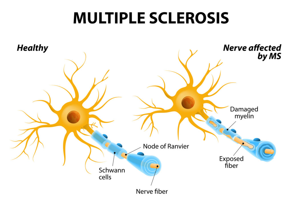 Sclérose en plaques et virus d’Epstein-Barr