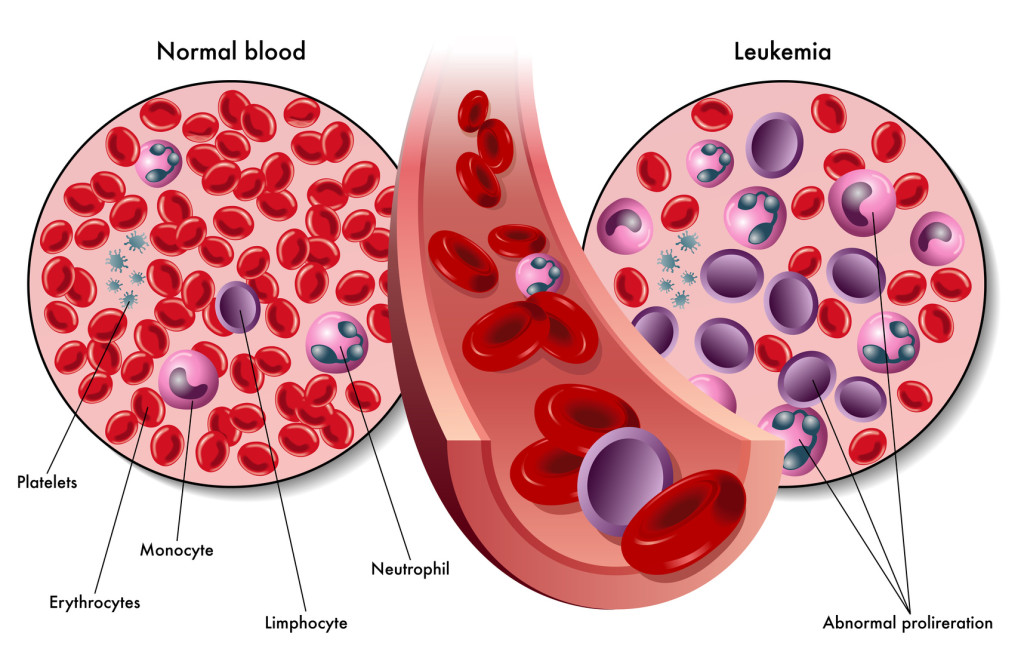 Leucémie et réponse immunitaire