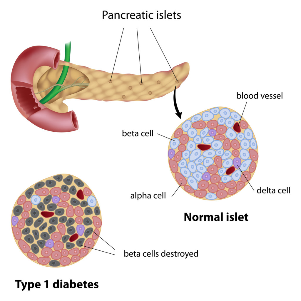 ¿Diabetes tipo 1?