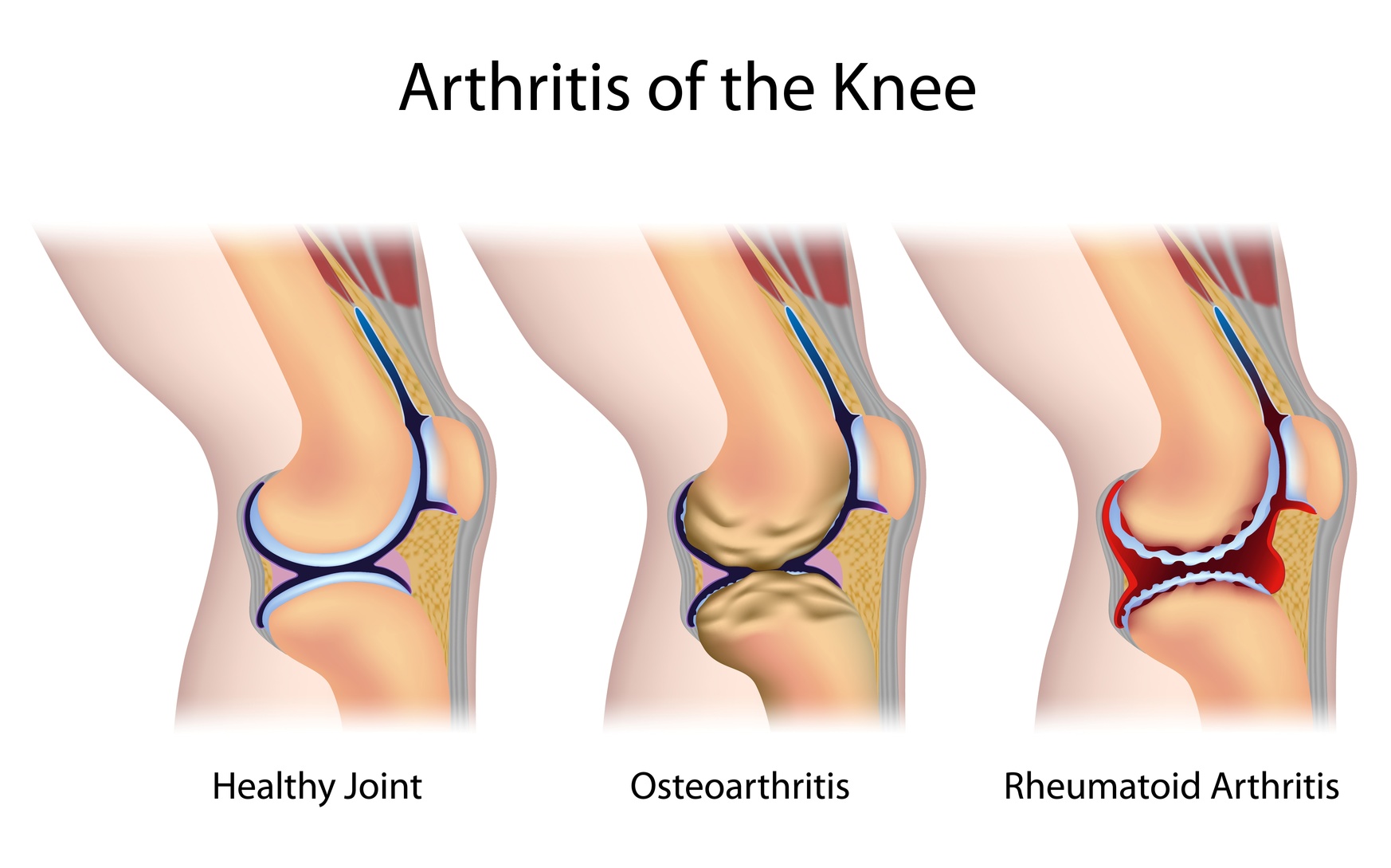 Arthrose et arthrite, deux maladies inflammatoires différentes ...